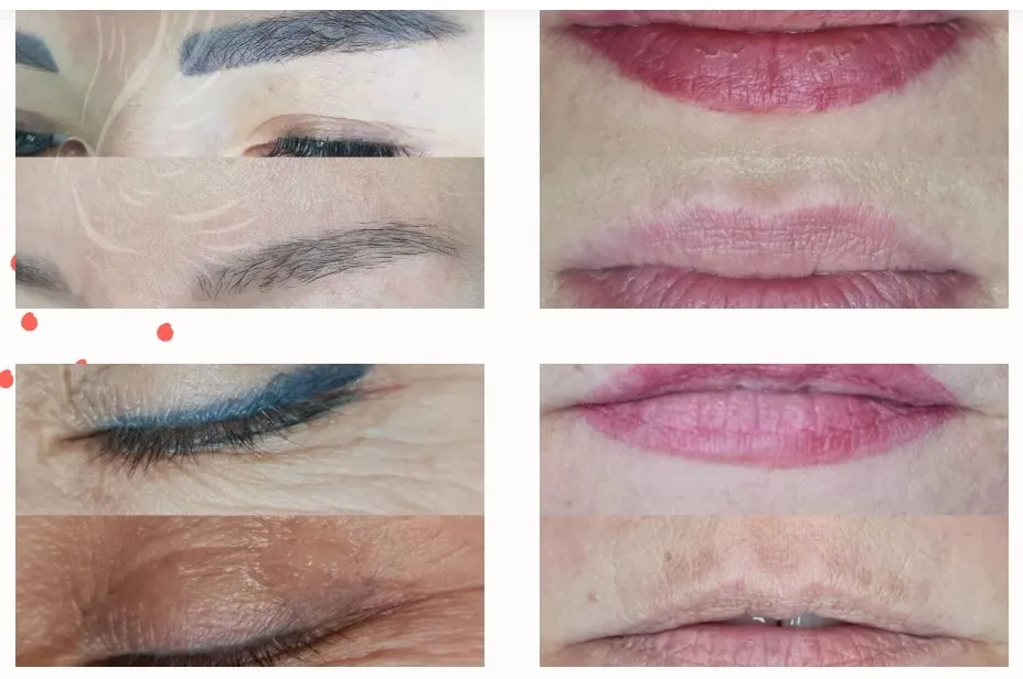 удаление татуажа