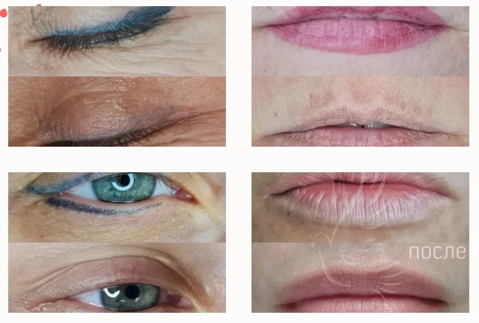 удаление татуажа